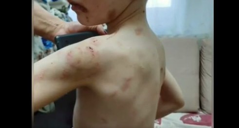 Cледы от побоев на теле ребенка. Стоп-кадр видео https://ok.ru/video/1483245947588 Cледы от побоев на теле ребенка. Стоп-кадр видео https://ok.ru/video/1483245947588