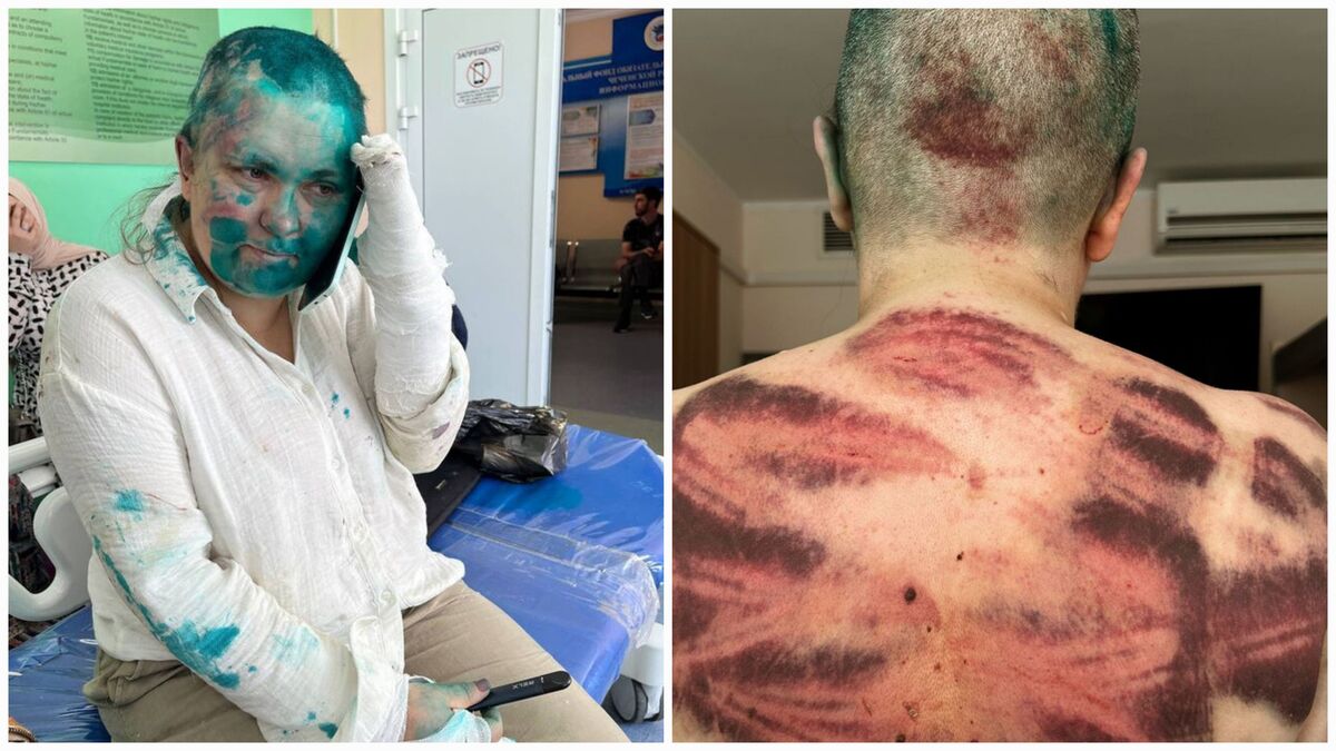 Елена Милашина в чеченской больнице. Фото: Сергея Бабинеца https://t.me/babinetssergey/849
Елена Милашина в московской клинике. Фото Анны Артемьевой / ”Новая газета”https://t.me/novaya_pishet/41070?single
