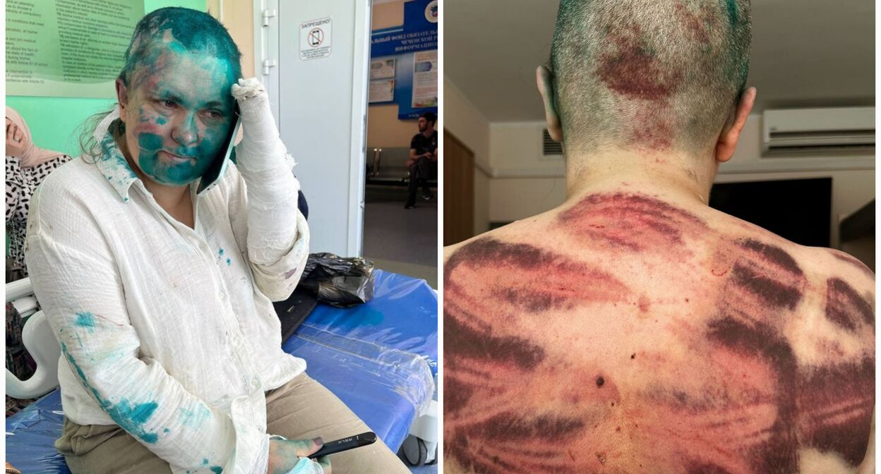 Елена Милашина в чеченской больнице. Фото: Сергея Бабинеца https://t.me/babinetssergey/849
Елена Милашина в московской клинике. Фото Анны Артемьевой / ”Новая газета”https://t.me/novaya_pishet/41070?single
