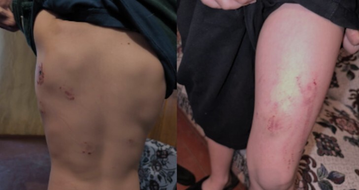 Травмы, нанесенные ребенку родственниками в Самегрело. Скриншот из репортажа TV Pirveli